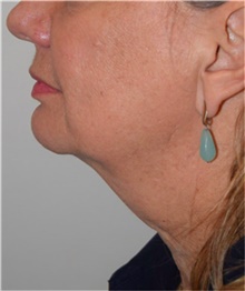 Facelift Before Photo by David Rapaport, MD; New York, NY - Case 40477