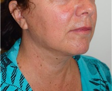 Facelift After Photo by David Rapaport, MD; New York, NY - Case 40478