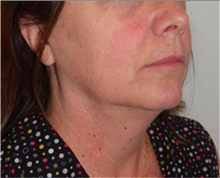Facelift Before Photo by David Rapaport, MD; New York, NY - Case 40478
