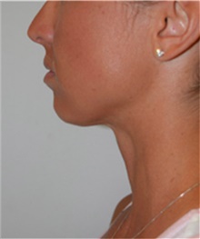 Liposuction After Photo by David Rapaport, MD; New York, NY - Case 40487
