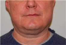 Liposuction Before Photo by David Rapaport, MD; New York, NY - Case 40489