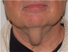 Liposuction Before Photo by David Rapaport, MD; New York, NY - Case 40490