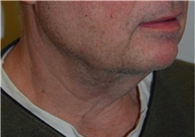 Liposuction After Photo by David Rapaport, MD; New York, NY - Case 40490