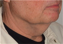 Liposuction Before Photo by David Rapaport, MD; New York, NY - Case 40490