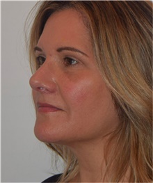 Rhinoplasty After Photo by David Rapaport, MD; New York, NY - Case 40492