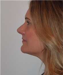 Rhinoplasty After Photo by David Rapaport, MD; New York, NY - Case 40492