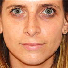 Rhinoplasty After Photo by David Rapaport, MD; New York, NY - Case 40496