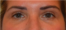Eyelid Surgery After Photo by David Rapaport, MD; New York, NY - Case 40498