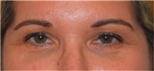 Eyelid Surgery Before Photo by David Rapaport, MD; New York, NY - Case 40498
