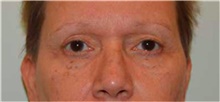 Eyelid Surgery Before Photo by David Rapaport, MD; New York, NY - Case 40499