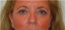 Eyelid Surgery After Photo by David Rapaport, MD; New York, NY - Case 40500
