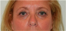 Eyelid Surgery Before Photo by David Rapaport, MD; New York, NY - Case 40500