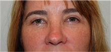Eyelid Surgery After Photo by David Rapaport, MD; New York, NY - Case 40501