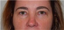 Eyelid Surgery Before Photo by David Rapaport, MD; New York, NY - Case 40501