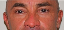 Eyelid Surgery After Photo by David Rapaport, MD; New York, NY - Case 40502