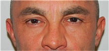 Eyelid Surgery Before Photo by David Rapaport, MD; New York, NY - Case 40502