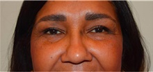 Eyelid Surgery After Photo by David Rapaport, MD; New York, NY - Case 40503