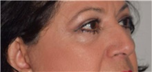 Eyelid Surgery After Photo by David Rapaport, MD; New York, NY - Case 40505