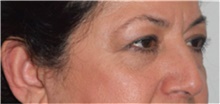 Eyelid Surgery Before Photo by David Rapaport, MD; New York, NY - Case 40505