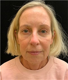 Eyelid Surgery After Photo by David Rapaport, MD; New York, NY - Case 45439
