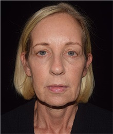 Eyelid Surgery Before Photo by David Rapaport, MD; New York, NY - Case 45439