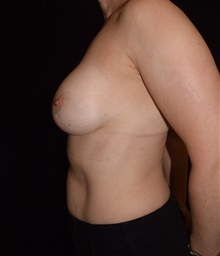 Breast Implant Revision After Photo by David Rapaport, MD; New York, NY - Case 46222