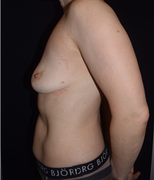 Breast Implant Revision Before Photo by David Rapaport, MD; New York, NY - Case 46222