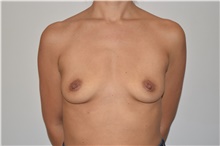Breast Augmentation Before Photo by David Rapaport, MD; New York, NY - Case 46228