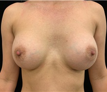 Breast Augmentation After Photo by David Rapaport, MD; New York, NY - Case 46229