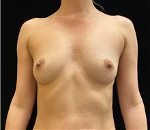 Breast Augmentation Before Photo by David Rapaport, MD; New York, NY - Case 46229