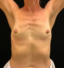 Breast Augmentation Before Photo by David Rapaport, MD; New York, NY - Case 46230