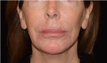 Injectable Fillers After Photo by David Rapaport, MD; New York, NY - Case 46556