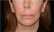 Injectable Fillers Before Photo by David Rapaport, MD; New York, NY - Case 46556