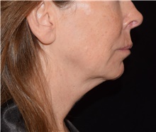 Injectable Fillers Before Photo by David Rapaport, MD; New York, NY - Case 46556