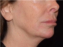 Injectable Fillers After Photo by David Rapaport, MD; New York, NY - Case 46556