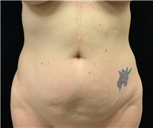 Tummy Tuck Before Photo by David Rapaport, MD; New York, NY - Case 46557