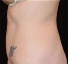 Tummy Tuck After Photo by David Rapaport, MD; New York, NY - Case 46557