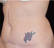 Tummy Tuck After Photo by David Rapaport, MD; New York, NY - Case 46557