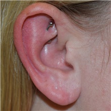 Ear Surgery After Photo by David Rapaport, MD; New York, NY - Case 46558
