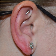 Ear Surgery After Photo by David Rapaport, MD; New York, NY - Case 46558