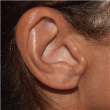 Ear Surgery After Photo by David Rapaport, MD; New York, NY - Case 46559
