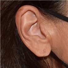 Ear Surgery Before Photo by David Rapaport, MD; New York, NY - Case 46559