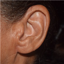Ear Surgery After Photo by David Rapaport, MD; New York, NY - Case 46559