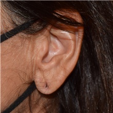 Ear Surgery Before Photo by David Rapaport, MD; New York, NY - Case 46559