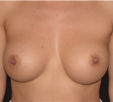 Breast Augmentation After Photo by David Rapaport, MD; New York, NY - Case 46560
