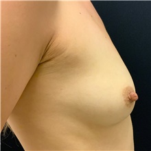 Breast Augmentation Before Photo by David Rapaport, MD; New York, NY - Case 46560