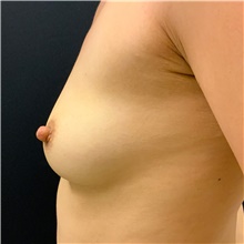 Breast Augmentation Before Photo by David Rapaport, MD; New York, NY - Case 46560