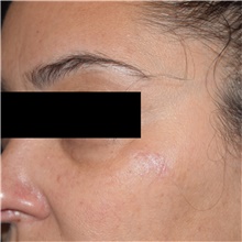 Skin rejuvenation and resurfacing After Photo by David Rapaport, MD; New York, NY - Case 46561