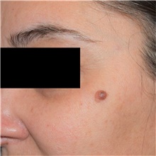 Skin rejuvenation and resurfacing Before Photo by David Rapaport, MD; New York, NY - Case 46561