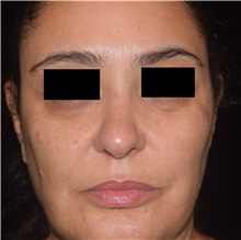 Skin rejuvenation and resurfacing After Photo by David Rapaport, MD; New York, NY - Case 46561